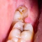 Cabut Gigi di Empire Dental Studio